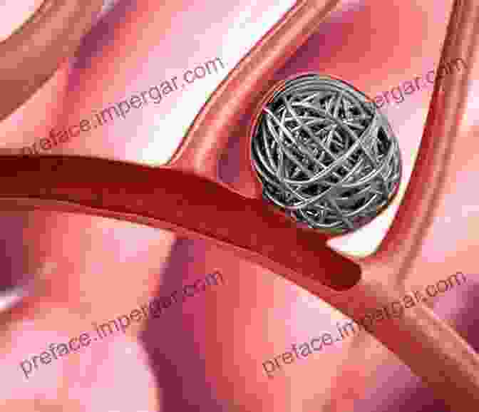 3D Illustration Of Embolization Procedures 3D Angiographic Atlas Of Neurovascular Anatomy And Pathology