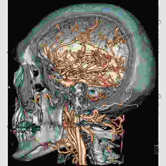 3D Reconstruction Of Cerebral Arterial Pathology 3D Angiographic Atlas Of Neurovascular Anatomy And Pathology