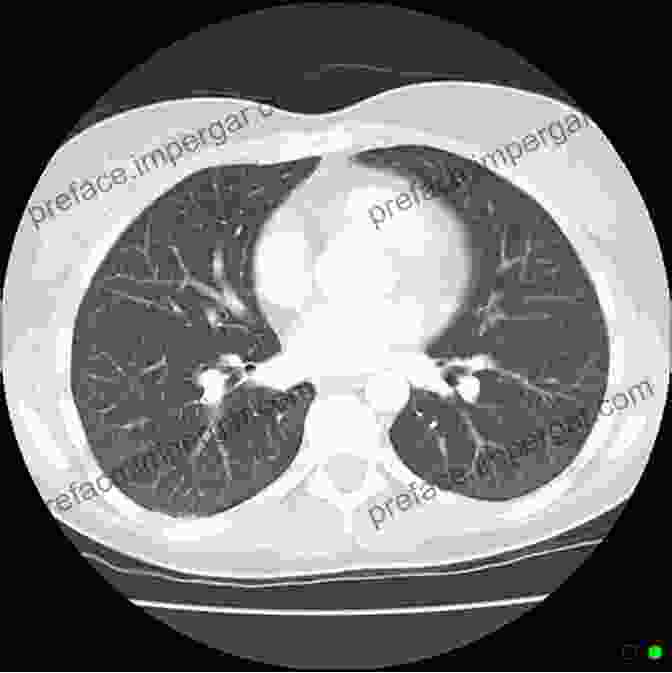 Example Of A CT Scan Of The Chest, Showing The Lungs, Heart, And Other Structures. Medical Imaging Of Normal And Pathologic Anatomy