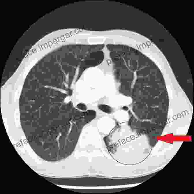 Image Of A Cancerous Tumor In The Lung, As Seen On A CT Scan. Medical Imaging Of Normal And Pathologic Anatomy